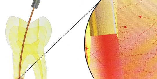 Wurzelbehandlung Laser Dentin Zahnarzt Holm Rennert