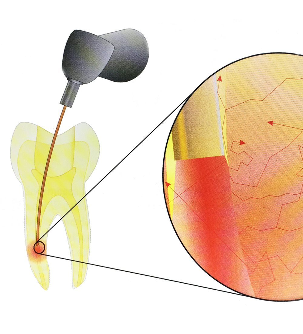 Wurzelbehandlung Laser Dentin Zahnarzt Holm Rennert